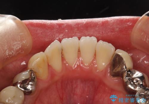 治療のスタート前に着色・ステインをPMTCできれいに除去の治療後