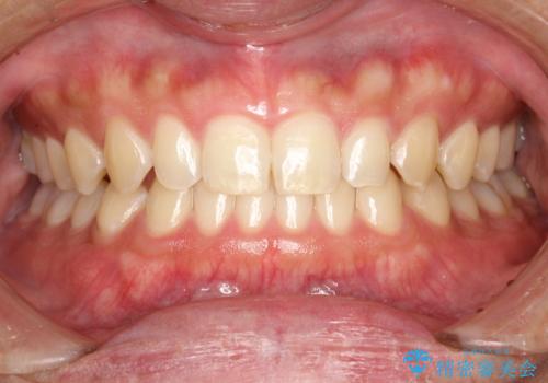 歯の染め出しとPMTCで歯ブラシ指導とクリーニングの治療前