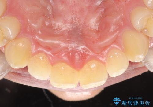 歯の染め出しとPMTCで歯ブラシ指導とクリーニングの治療前