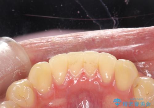 歯の染め出しとPMTCで歯ブラシ指導とクリーニングの治療前