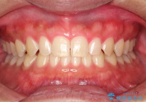 歯の染め出しとPMTCで歯ブラシ指導とクリーニングの治療後