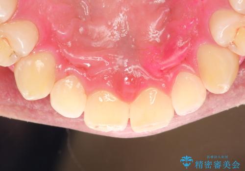 歯の染め出しとPMTCで歯ブラシ指導とクリーニングの症例 治療後