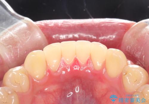 歯の染め出しとPMTCで歯ブラシ指導とクリーニングの治療後