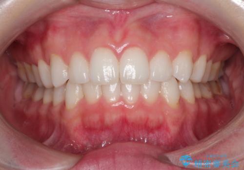 前歯のがたつきをインビザラインで目立たず矯正治療の治療後