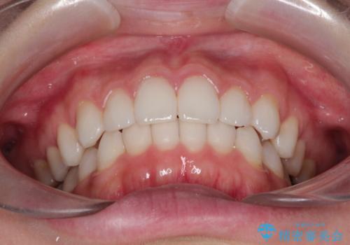 前歯のがたつきをインビザラインで目立たず矯正治療の治療後