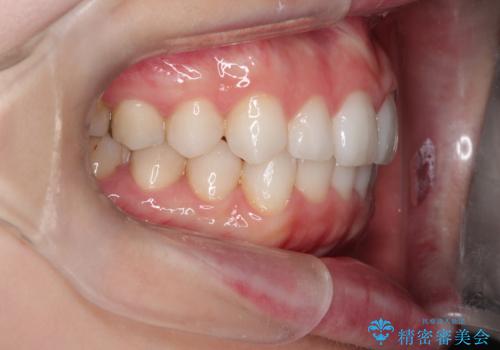前歯のがたつきをインビザラインで目立たず矯正治療の治療後