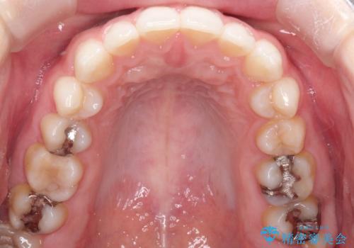 前歯のがたつきをインビザラインで目立たず矯正治療の治療後