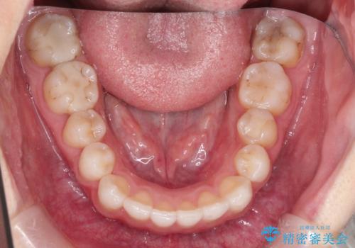 前歯のがたつきをインビザラインで目立たず矯正治療の症例 治療後