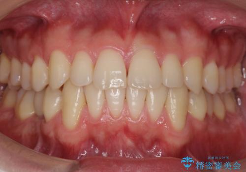すきっ歯・出っ歯が気になる　インビザライン矯正　乳歯をインプラントにの症例 治療後