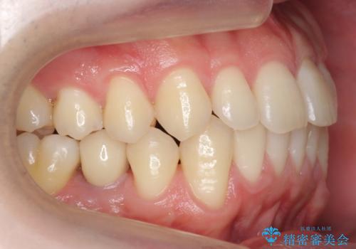 すきっ歯・出っ歯が気になる　インビザライン矯正　乳歯をインプラントにの治療後