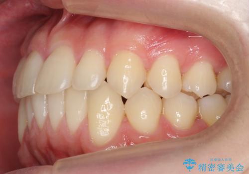 すきっ歯・出っ歯が気になる インビザライン矯正 乳歯をインプラントにの治療後