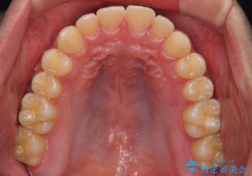 すきっ歯・出っ歯が気になる インビザライン矯正 乳歯をインプラントにの治療後