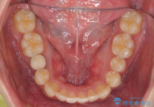 すきっ歯・出っ歯が気になる インビザライン矯正 乳歯をインプラントにの治療後