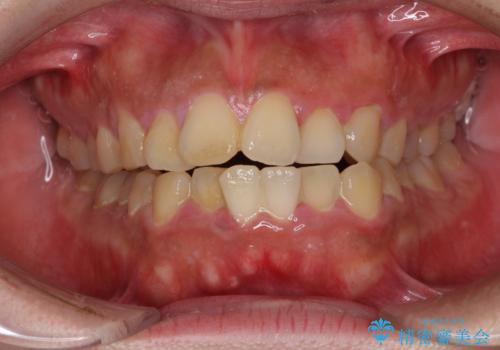 口元の突出感を改善　ワイヤー装置による抜歯矯正の症例 治療前