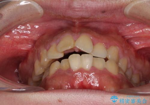 口元の突出感を改善　ワイヤー装置による抜歯矯正の治療前