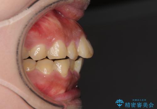 口元の突出感を改善 ワイヤー装置による抜歯矯正の治療前