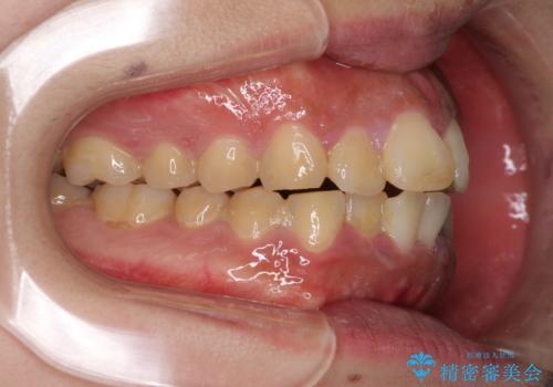 口元の突出感を改善　ワイヤー装置による抜歯矯正の治療前