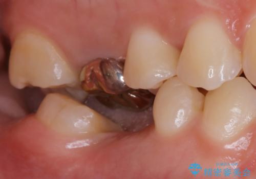 部分矯正を併用したブリッジ治療の症例 治療前