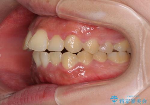 口元の突出感を改善 ワイヤー装置による抜歯矯正の治療前