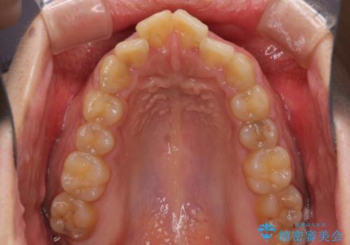 口元の突出感を改善 ワイヤー装置による抜歯矯正の治療前