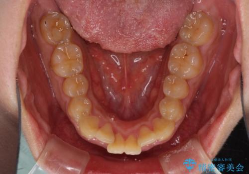 口元の突出感を改善 ワイヤー装置による抜歯矯正の治療前