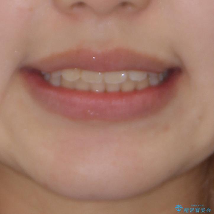 短期間で終了 デコボコをワイヤー矯正で解消の治療後(顔貌)