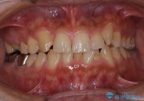 矯正治療を考えている方の歯のクリーニングの治療前
