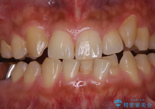 矯正治療を考えている方の歯のクリーニングの治療前