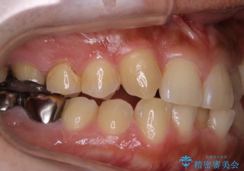 矯正治療を考えている方の歯のクリーニングの治療前