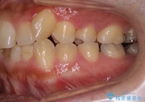 矯正治療を考えている方の歯のクリーニングの治療前