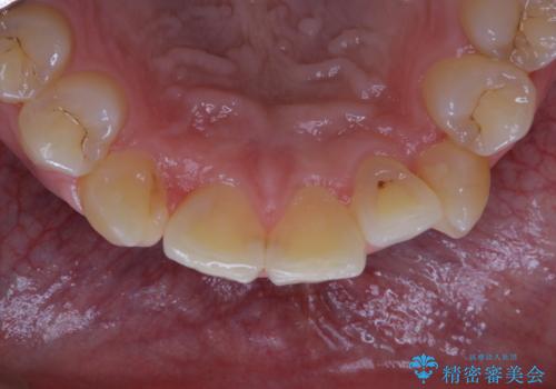 矯正治療を考えている方の歯のクリーニングの治療前