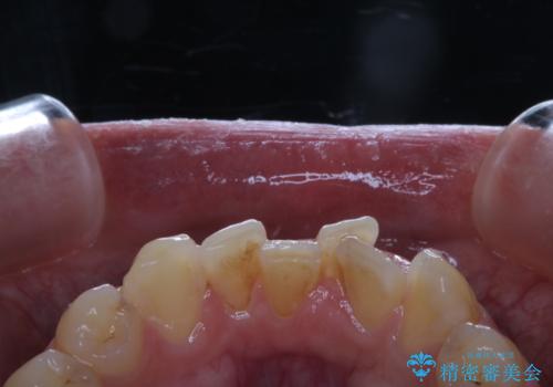 矯正治療を考えている方の歯のクリーニングの治療前