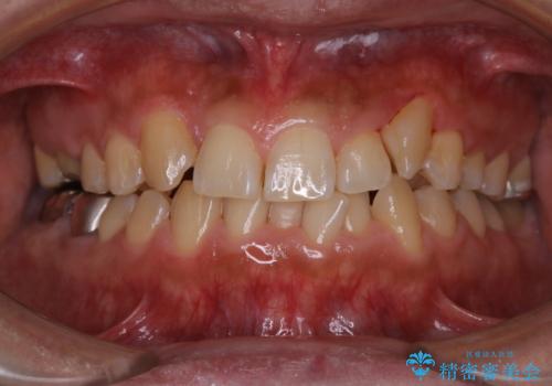 矯正治療を考えている方の歯のクリーニングの治療後