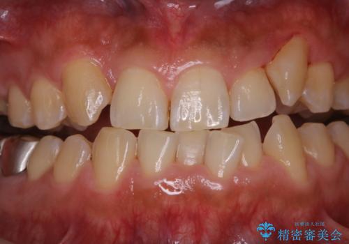 矯正治療を考えている方の歯のクリーニングの症例 治療後