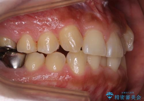 矯正治療を考えている方の歯のクリーニングの治療後