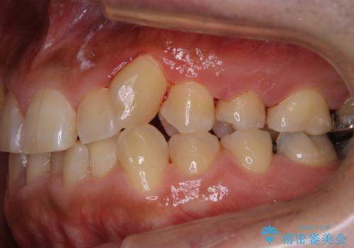 矯正治療を考えている方の歯のクリーニングの治療後