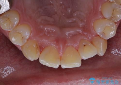 矯正治療を考えている方の歯のクリーニングの治療後