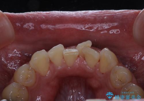 矯正治療を考えている方の歯のクリーニングの治療後