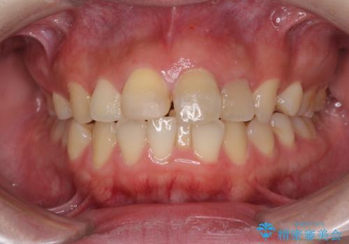 抜歯矯正の後戻り インビザラインによるオープンバイトの再矯正の症例 治療前