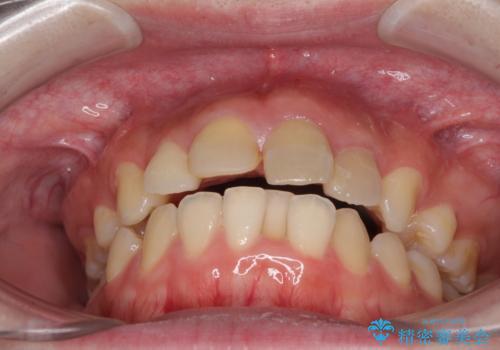 抜歯矯正の後戻り インビザラインによるオープンバイトの再矯正の治療前