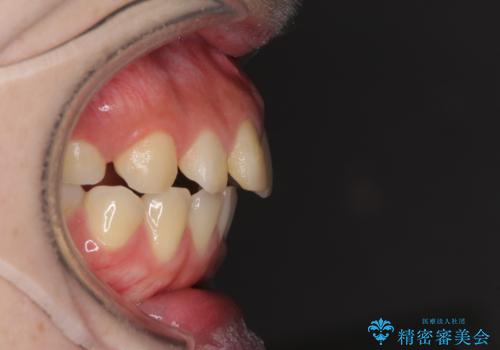抜歯矯正の後戻り インビザラインによるオープンバイトの再矯正の治療前