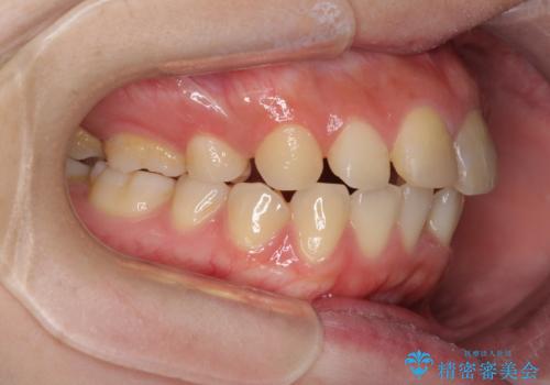 抜歯矯正の後戻り インビザラインによるオープンバイトの再矯正の治療前