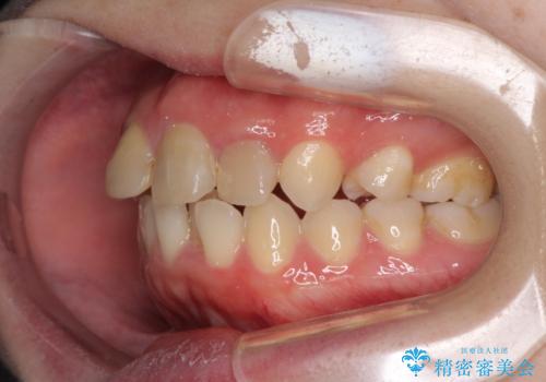 抜歯矯正の後戻り インビザラインによるオープンバイトの再矯正の治療前
