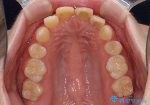 抜歯矯正の後戻り インビザラインによるオープンバイトの再矯正の治療前