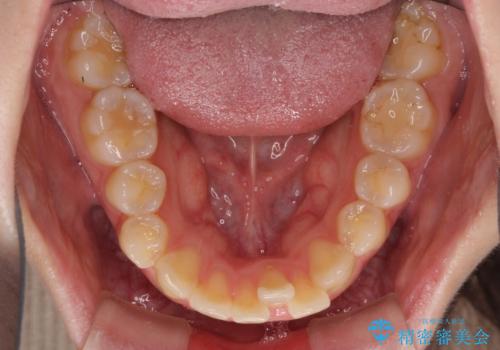 抜歯矯正の後戻り インビザラインによるオープンバイトの再矯正の治療前