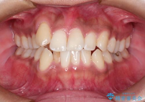 インビザラインと補助装置の併用による八重歯の抜歯矯正