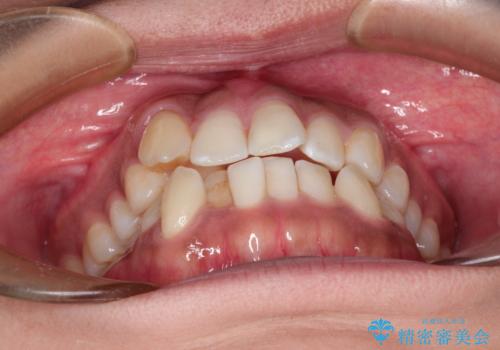 インビザラインと補助装置の併用による八重歯の抜歯矯正の治療前