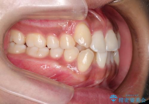 インビザラインと補助装置の併用による八重歯の抜歯矯正の治療前