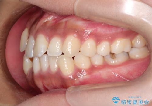 インビザラインと補助装置の併用による八重歯の抜歯矯正の治療前