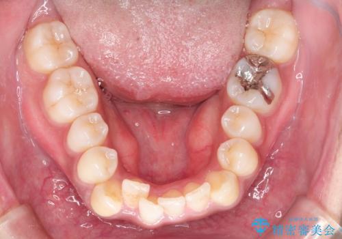 インビザラインと補助装置の併用による八重歯の抜歯矯正の治療前